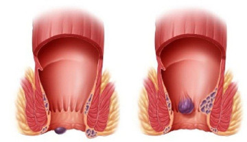 Những điều cần biết về bệnh trĩ